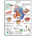 Picture of Arthritis Chart